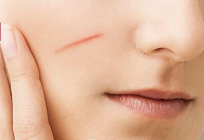 脸上疤痕怎么淡化 祛疤方法效果分享